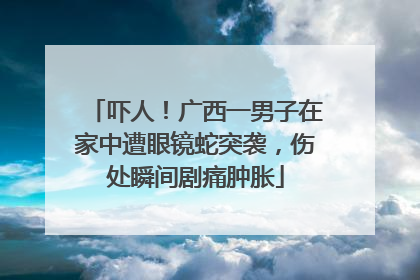 吓人！广西一男子在家中遭眼镜蛇突袭，伤处瞬间剧痛肿胀